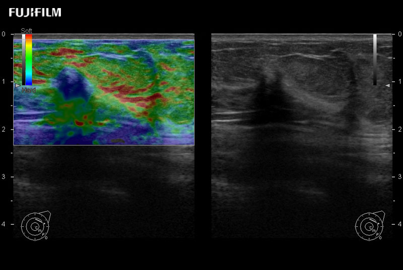 Breast Lesion Elastography