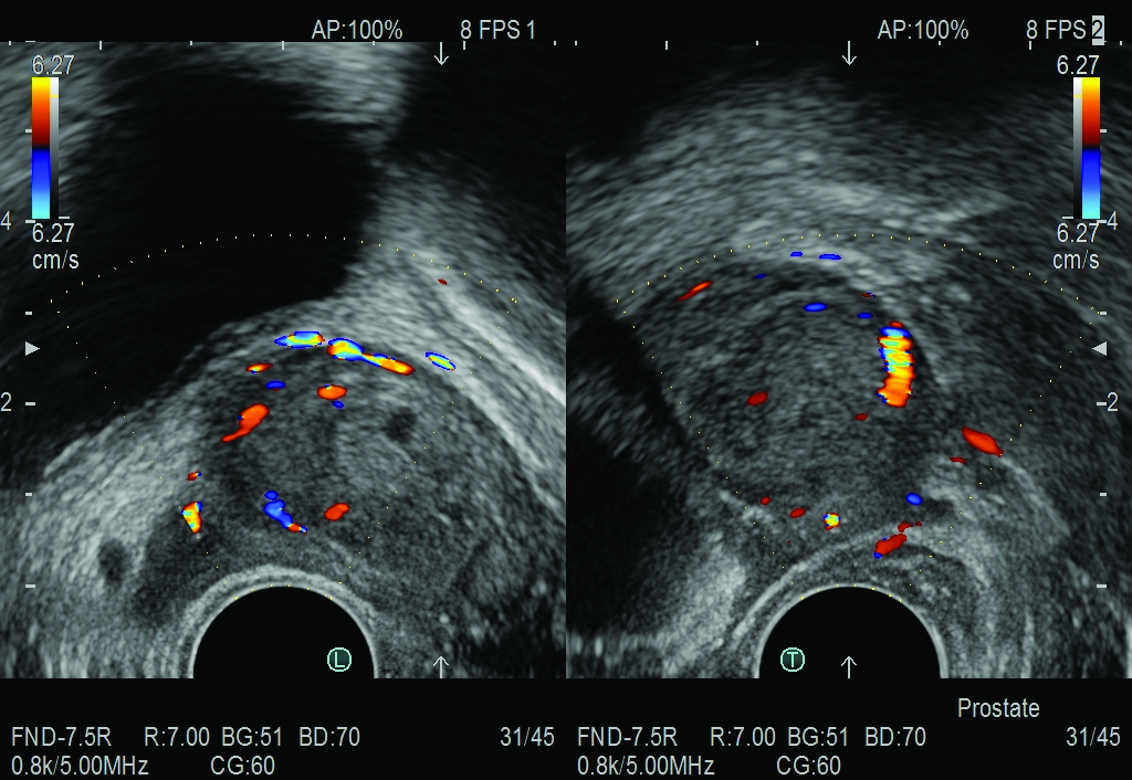 Prostate Imaging using the CC41R2 Transducer