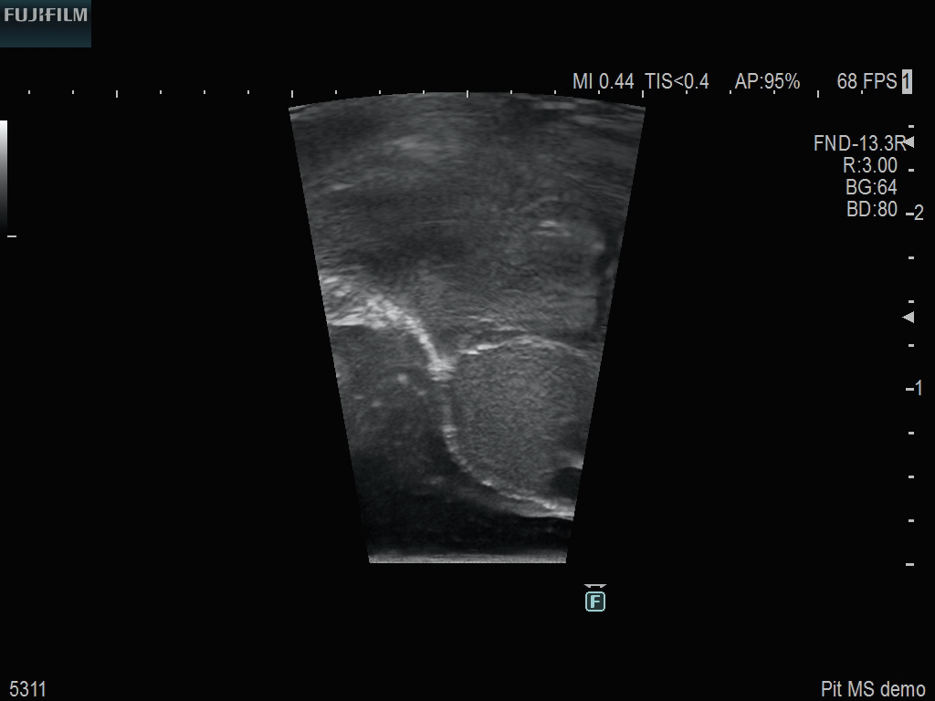Pituitary Procedure using UST-5311