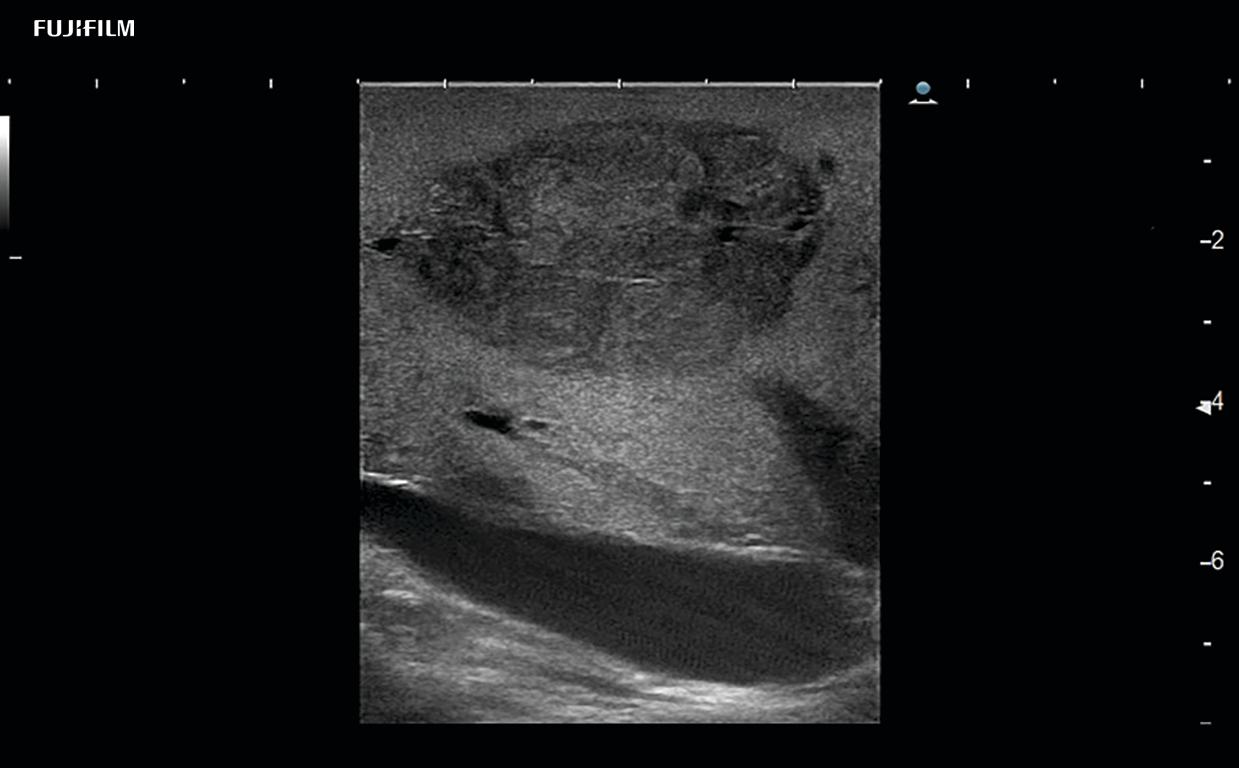 Liver Surgery Procedure using L46K1