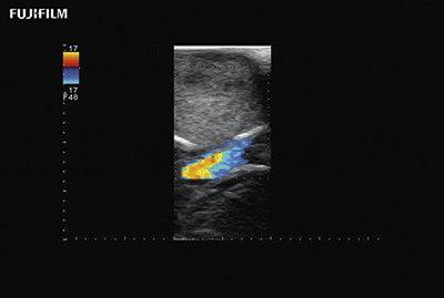 Pituitary Procedure using UST-5311