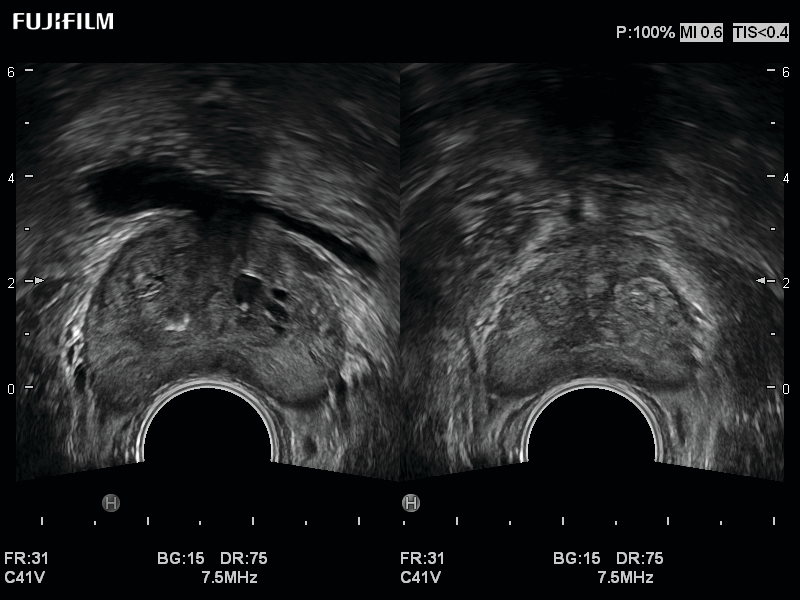 Prostate imaging using the C41V Transducer